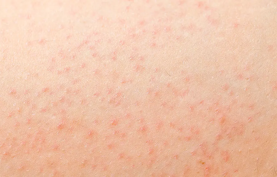 Follicolite gambe: cosa è, rimedi e prevenzione