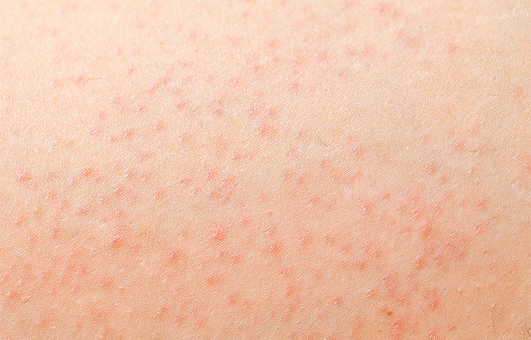 Follicolite gambe: cosa è, rimedi e prevenzione