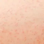 Follicolite gambe: cosa è, rimedi e prevenzione